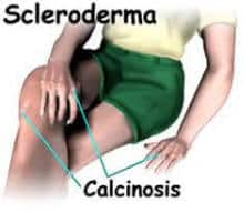 scleroderma