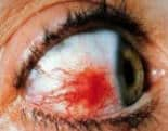 episcleritis