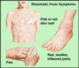 Rheumatic Fever Symptoms