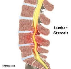 spinal stenosis